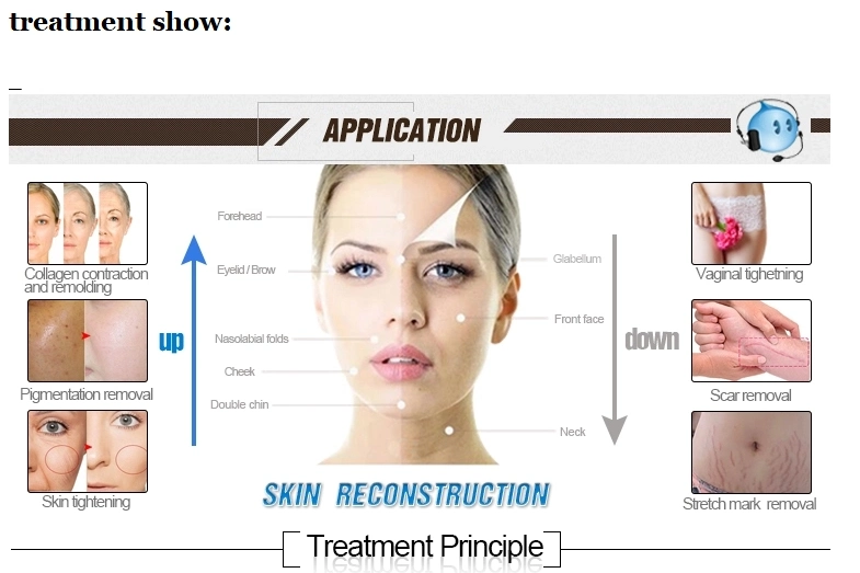 Super Result Acne Scar Removal CO2 Fractional Laser Equipment/RF Tube CO2/CO2 Wart Laser/Equipo Laser CO2 Fraccionado Vaginal